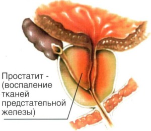 что такое простатит