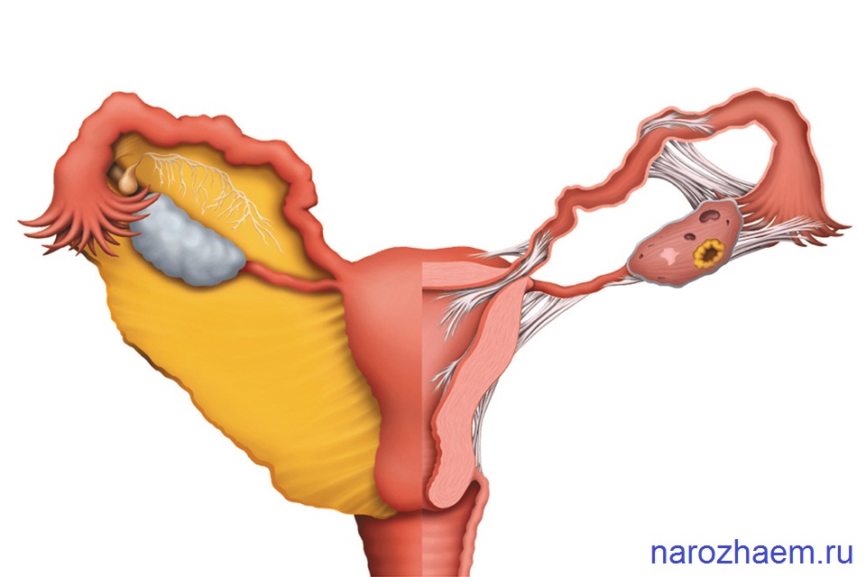 Что такое спаечный процесс в малом тазу